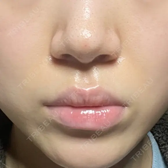 ボトックス（口角） / ヒアルロン酸注入（鼻翼基部） ルラ美容クリニック 大阪本院 BEFORE メイン用