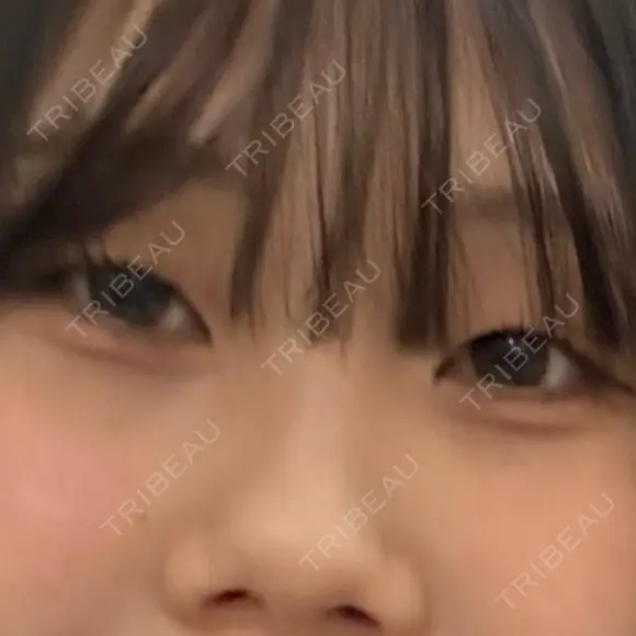 ヒアルロン酸注入（涙袋） フィラークリニック 大阪心斎橋院 BEFORE メイン用