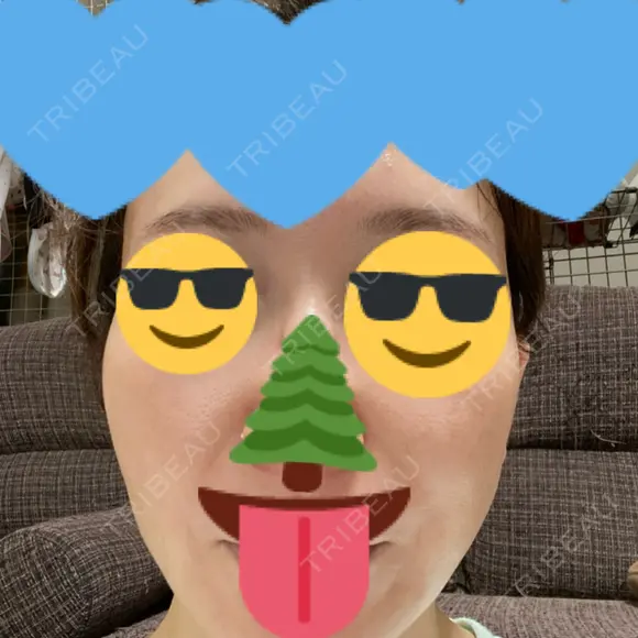 肌育注射（ジュベルックなど） / RF（高周波）たるみ治療 大美会クリニック 梅田院 BEFORE メイン用