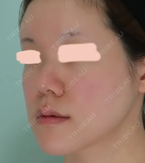 隆鼻術 / 鼻尖形成（切開） / 鼻中隔延長（切開） / 軟骨移植 / 骨切幅寄せ / 鼻孔縁挙上 / 鼻翼基部形成（貴族手術） / 鼻柱下降・鼻唇角形成（猫手術） WOM CLINIC GINZA （ワム クリニック ギンザ） BEFORE メイン用