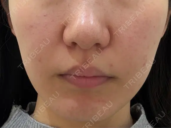 ポテンツァ 渋谷美容外科クリニック 横浜院 BEFORE メイン用