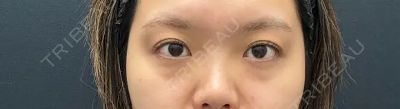 クマ治療 湘南美容クリニック 千葉センシティ院 BEFORE メイン用