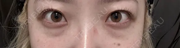 クマ治療 / 下まぶたたるみ取り / 下まぶたの脂肪取り / ヒアルロン酸注入（目の下） / スネコス 新宿美容外科ネビュラクリニック BEFORE メイン用