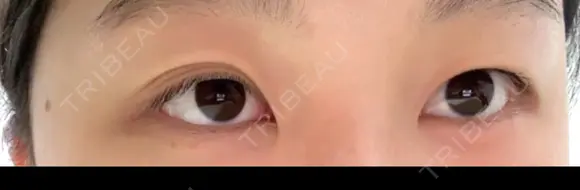 二重埋没 湘南美容クリニック 千葉センシティ院 BEFORE メイン用