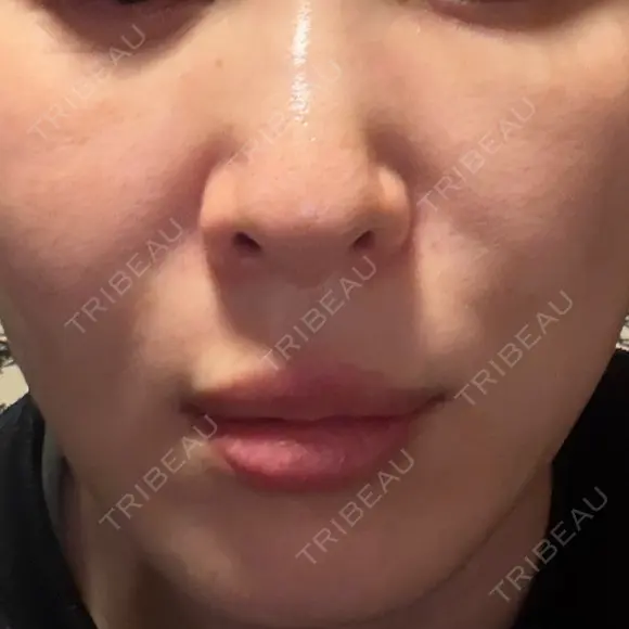 スネコス ミニマムスキンクリニック池袋 BEFORE メイン用