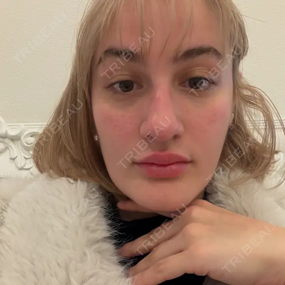 糸リフト A CLINIC（エークリニック） 横浜院 BEFORE メイン用