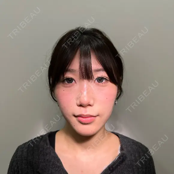 ヒアルロン酸注入（涙袋） / ヒアルロン酸注入（鼻） / ヒアルロン酸注入（あご） / ヒアルロン酸注入（唇） / ヒアルロン酸注入（頬） / ボトックス（肩） / ヒアルロン酸注入（鼻翼基部） HAAB×DREAM BEAUTY CLINIC 大阪梅田院 BEFORE メイン用