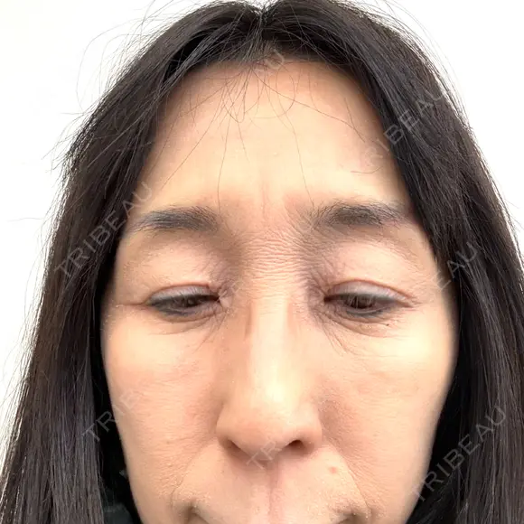 スネコス Natural Skin Clinic 自由ヶ丘院 BEFORE メイン用