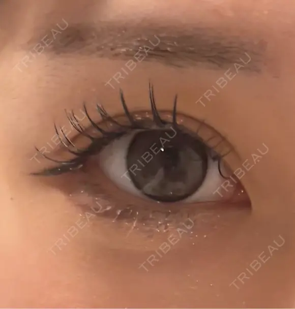 ヒアルロン酸注入（涙袋） フィラークリニック 大阪心斎橋院 BEFORE メイン用