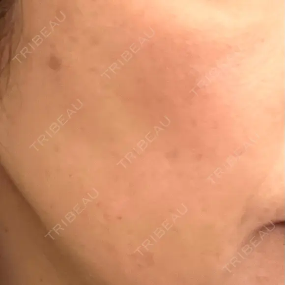 プラセンタ注射 / シミ取りレーザー S-Laboクリニック 渋谷院 BEFORE メイン用