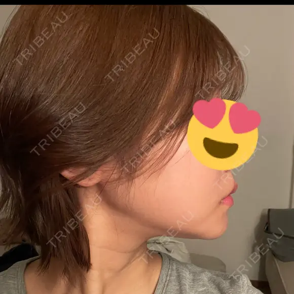 ハイフ（顔） HINATA クリニック BEFORE メイン用