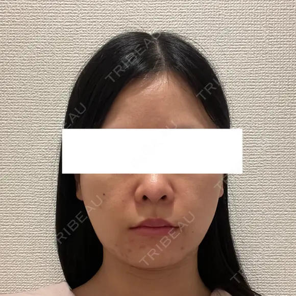 脂肪吸引（顔） ルラ美容クリニック 新宿院 BEFORE メイン用