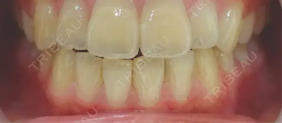 その他（口元） 銀座本院 歯と美容のクリニック BEFORE メイン用