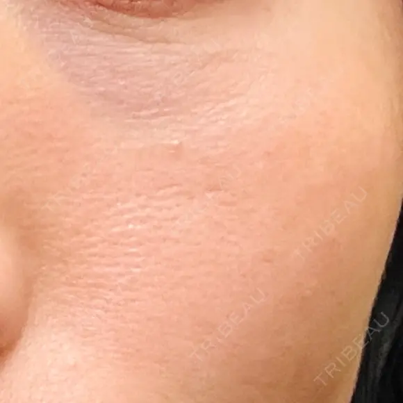 美肌レーザー LEX BEAUTY CLINIC BEFORE メイン用