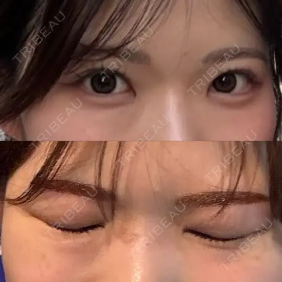 ヒアルロン酸注入（涙袋） PRO CLINIC プロクリニック 銀座院 BEFORE メイン用