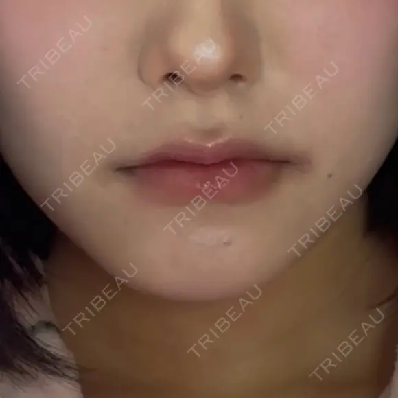 ヒアルロン酸注入（あご） ECLA CLINIC (エクラクリニック) BEFORE メイン用