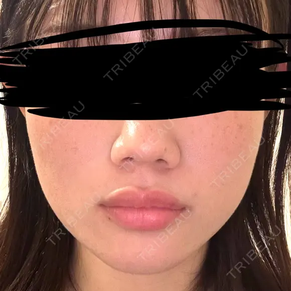 ボトックス（エラ・小顔） DMTC CLINIC 日本橋院 BEFORE メイン用