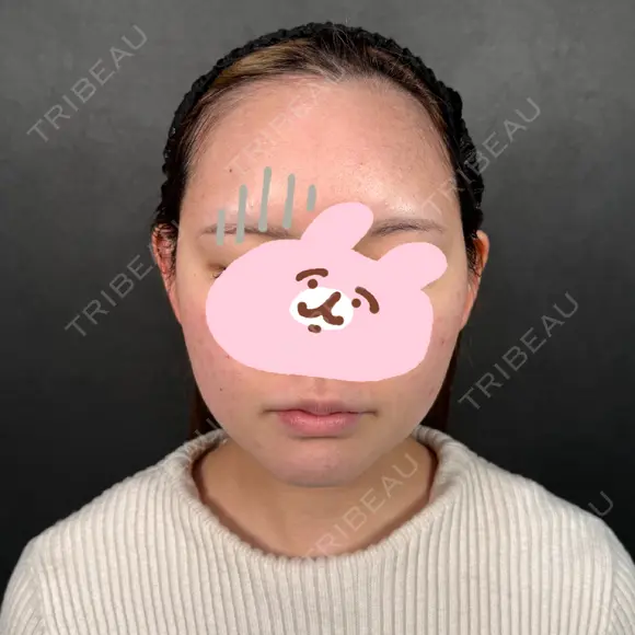 糸リフト / 脂肪吸引（顔） / ジョールファット除去 新宿美容外科ネビュラクリニック BEFORE メイン用