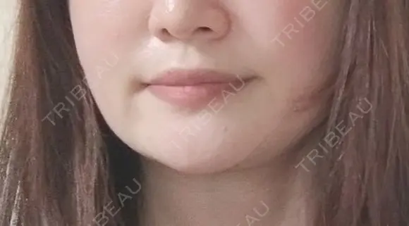 オンダリフト RIVER CLINIC（リバークリニック） BEFORE メイン用