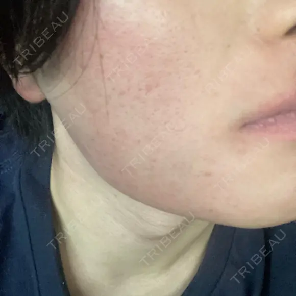 医療脱毛（顔） ZX-CLINIC 梅田院 BEFORE メイン用