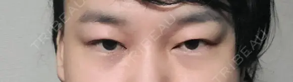 クマ治療 / 下まぶたたるみ取り 湘南美容クリニック 千葉センシティ院 BEFORE メイン用