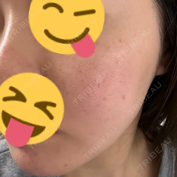 光治療（フォトフェイシャルなど） / ルメッカ 眠れるスキンクリニック田町 BEFORE メイン用