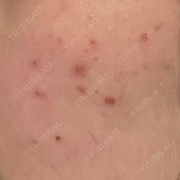 その他（肌） / ポテンツァ ルラ美容クリニック 郡山院 BEFORE メイン用