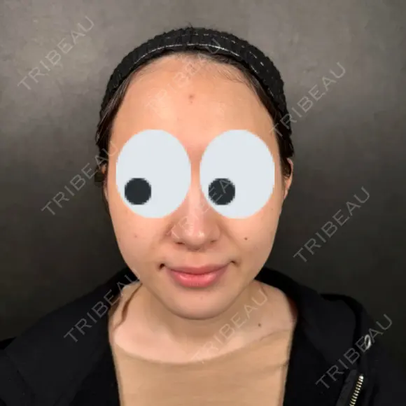 糸リフト / 脂肪吸引（顔） / ジョールファット除去 新宿美容外科ネビュラクリニック BEFORE メイン用