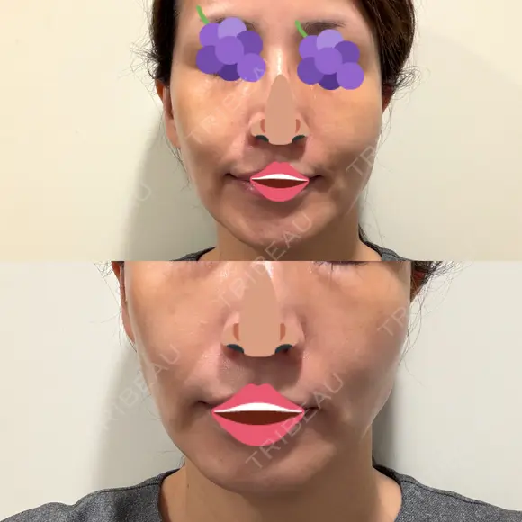 オリジオ PRISM Beauty Clinic 新宿院 BEFORE メイン用