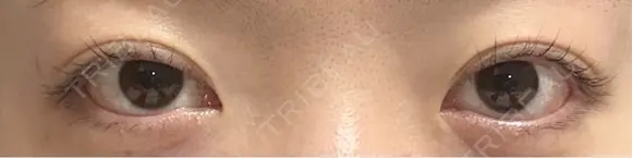 二重切開 EMMA CLINIC（エマクリニック） BEFORE メイン用