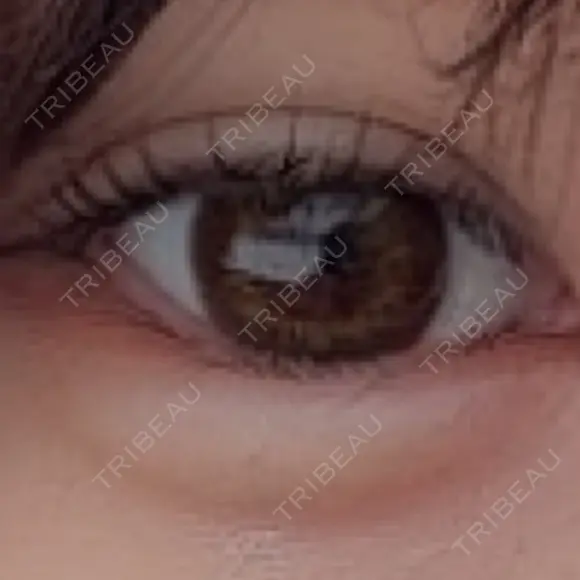 ヒアルロン酸注入（涙袋） ルラ美容クリニック 渋谷本院 BEFORE メイン用