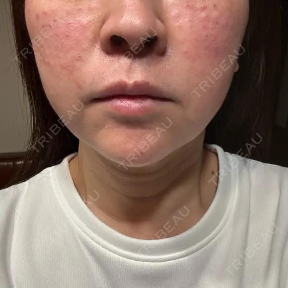 ボトックス（あご） / ボトックス（口角） / ボトックス（眉間） / ボトックス（目尻） / ボトックス（額） / 肌育注射（ジュベルックなど） 千葉美容外科アイビークリニック BEFORE メイン用