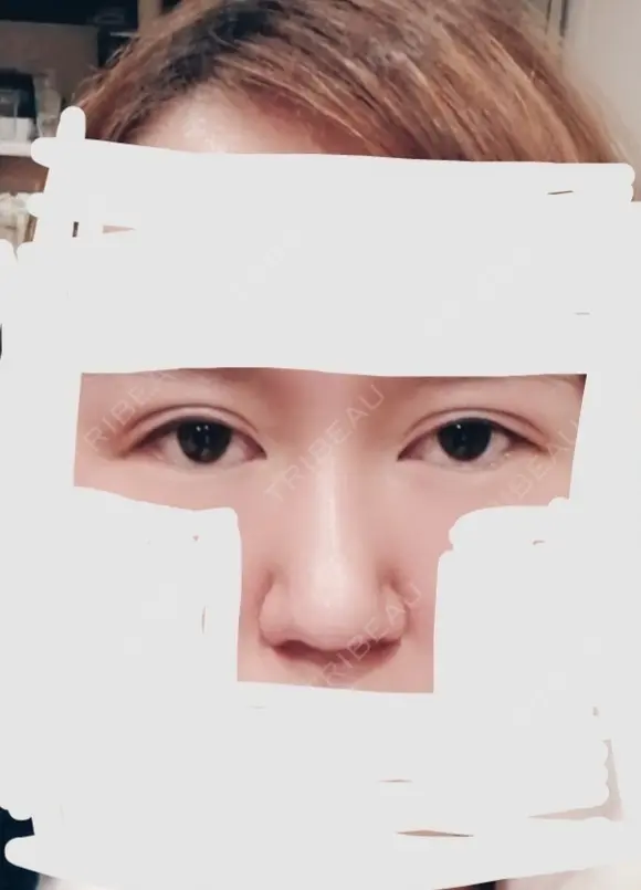 眼瞼下垂（切開） / 隆鼻術 / 鼻尖形成（切開） / 鼻中隔延長（切開） / 軟骨移植 アネシス美容クリニック BEFORE メイン用