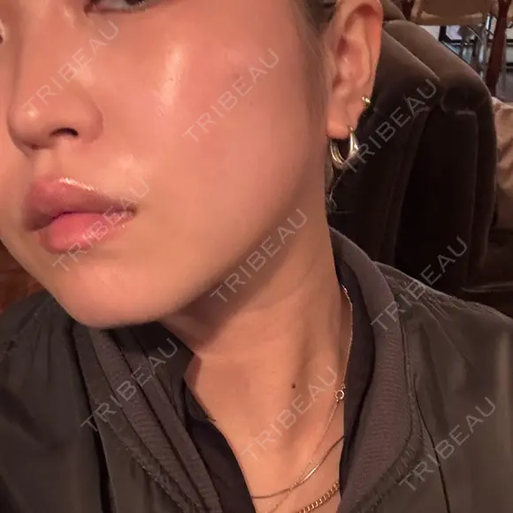 ボトックス（エラ・小顔） 新未来クリニック BEFORE メイン用