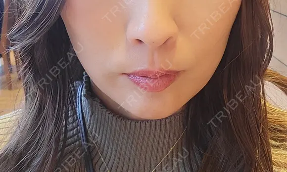 ボトックス（口角） eクリニック 岡山院 BEFORE メイン用