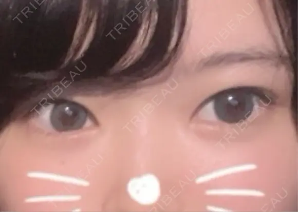 二重埋没 TCB東京中央美容外科 奈良院 BEFORE メイン用