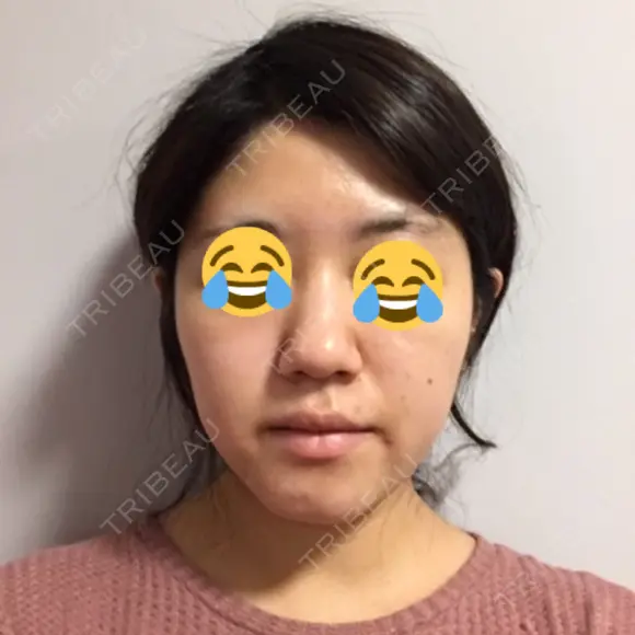 骨切り（あご） / 骨削り（エラ） / 骨削り（頬） / 脂肪吸引（顔） / 脂肪注入（額） / 脂肪溶解注射（顔） View美容整形外科 BEFORE メイン用