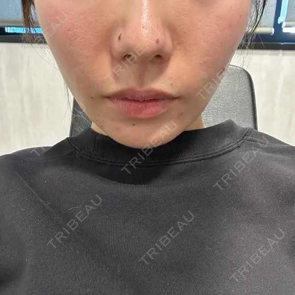 ボトックス（ガミースマイル） / ヒアルロン酸注入（鼻翼基部） ziz CLINIC BEFORE メイン用