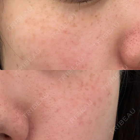 ピーリング（ハリ・ツヤ） / ルメッカ ルラ美容クリニック 札幌本院 BEFORE メイン用