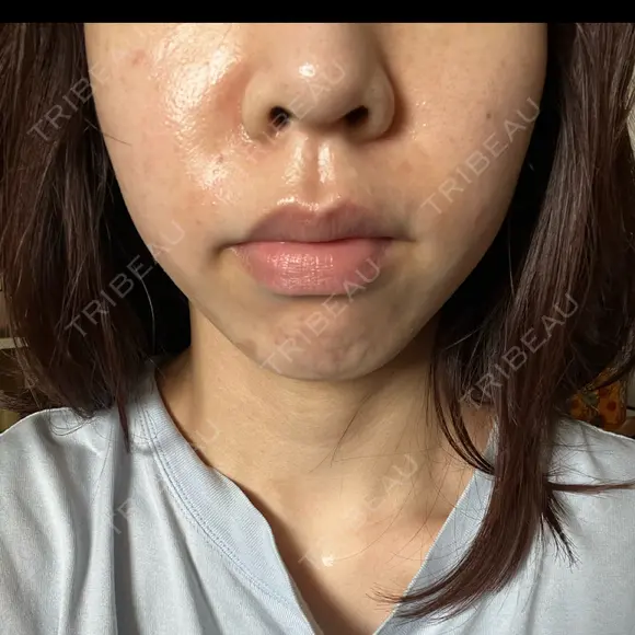 医療脱毛（顔） ダビデクリニック渋谷 BEFORE メイン用