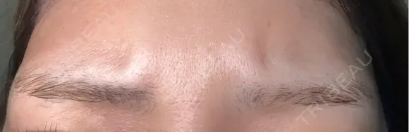 ボトックス（あご） / ボトックス（エラ・小顔） / ボトックス（口角） / ボトックス（眉間） / ボトックス（額） / ボトックス（首） 大美会クリニック 神戸院 BEFORE メイン用