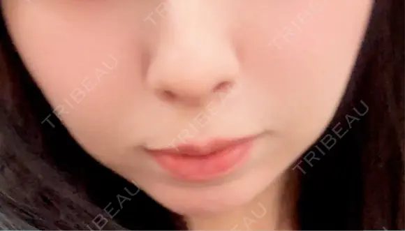 チタニウムリフト 博多美容外科/美容皮膚科 ビラビューティークリニック BEFORE メイン用