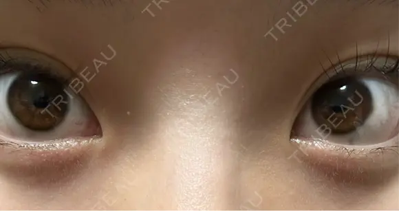 目頭切開 新宿美容外科ネビュラクリニック BEFORE メイン用