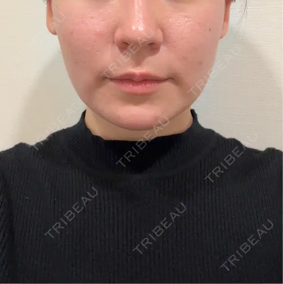 糸リフト ガーデンクリニック 船橋院 BEFORE メイン用