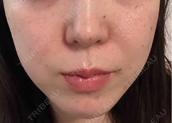 ピーリング（ニキビ・毛穴） / ピーリング（ハリ・ツヤ） / ルメッカ ハナビューティークリニック BEFORE メイン用