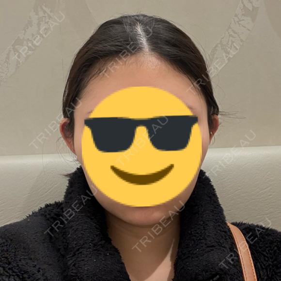 二重埋没 / 糸リフト 銀座みゆき通り美容外科 大阪梅田院 BEFORE メイン用
