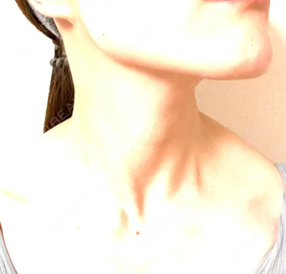 ボトックス（エラ・小顔） DMTC CLINIC 日本橋院 BEFORE メイン用