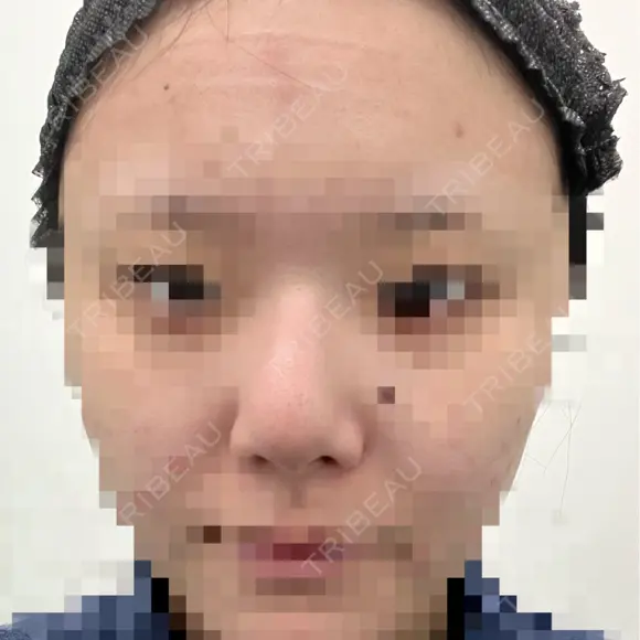 鼻尖形成（切開） / 軟骨移植 / 眉間プロテーゼ BAYASHI CLINIC BEFORE メイン用