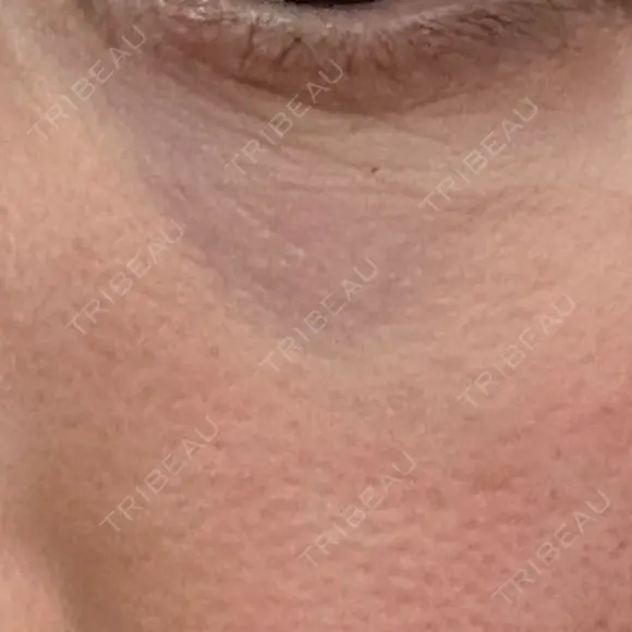 その他（目元） 品川スキンクリニック広島院 BEFORE メイン用