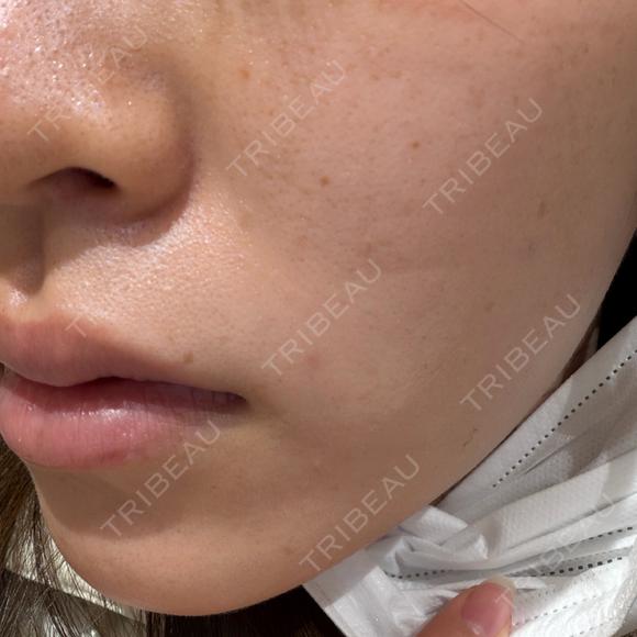 エレクトロポレーション BITO BEAUTY CLINIC BEFORE メイン用